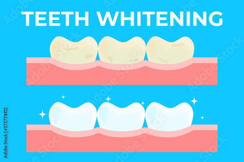 Teeth whitening or bleaching vector illustration. Concept of dental healthcare, stomatology care, professional tooth cleaning service.