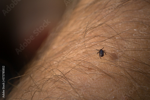 Tick Acari mite on human skin. Dangerous insects.