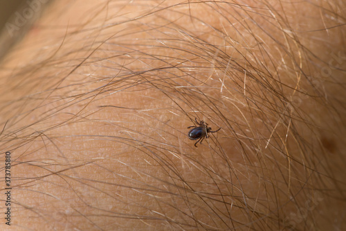 Tick Acari mite on human skin. Dangerous insects.