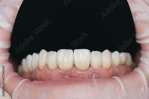 Obraz na plátně Closeup photo with zirconium artificial teeth. Zirconium crowns
