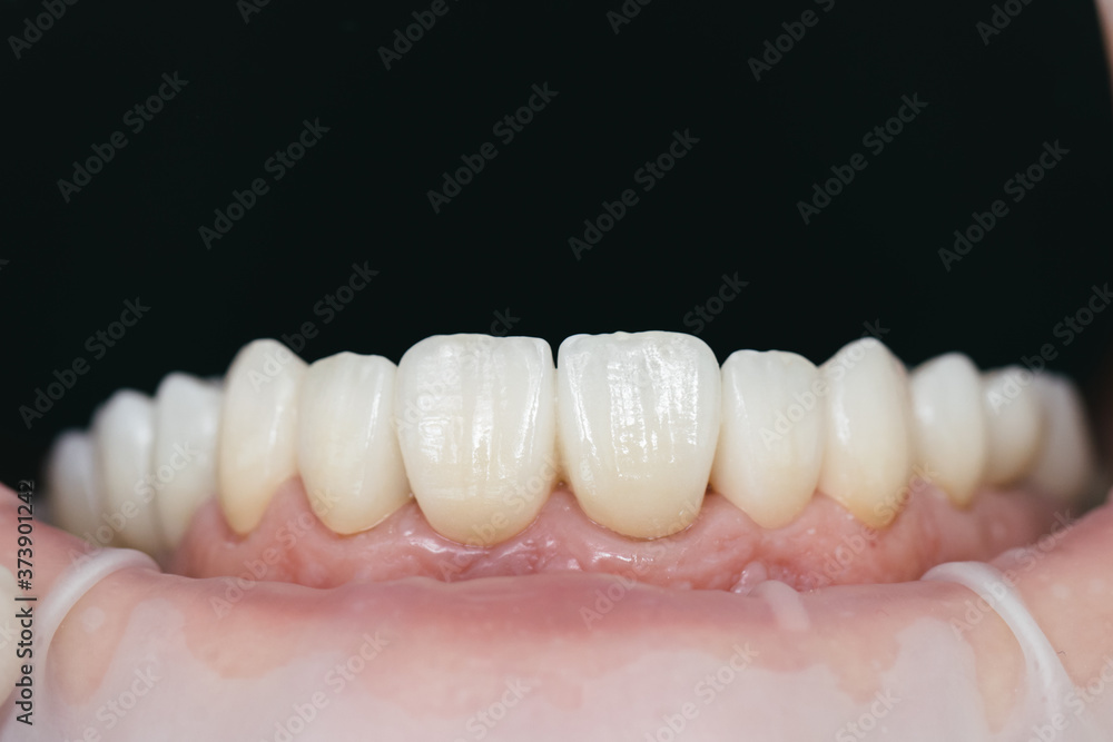 Dental health care. Ceramic zirconium in final version. Staining and glazing. Precision design and high quality materials Dental health care. Ceramic zirconium in final version. Staining and glazing. Precision design and high quality materials