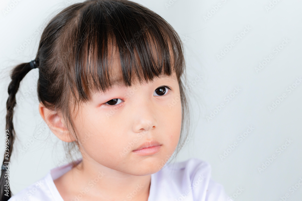 Asian girl with red pink eye inflammation blepharitis from allergy Asian girl with red pink eye inflammation blepharitis from allergy