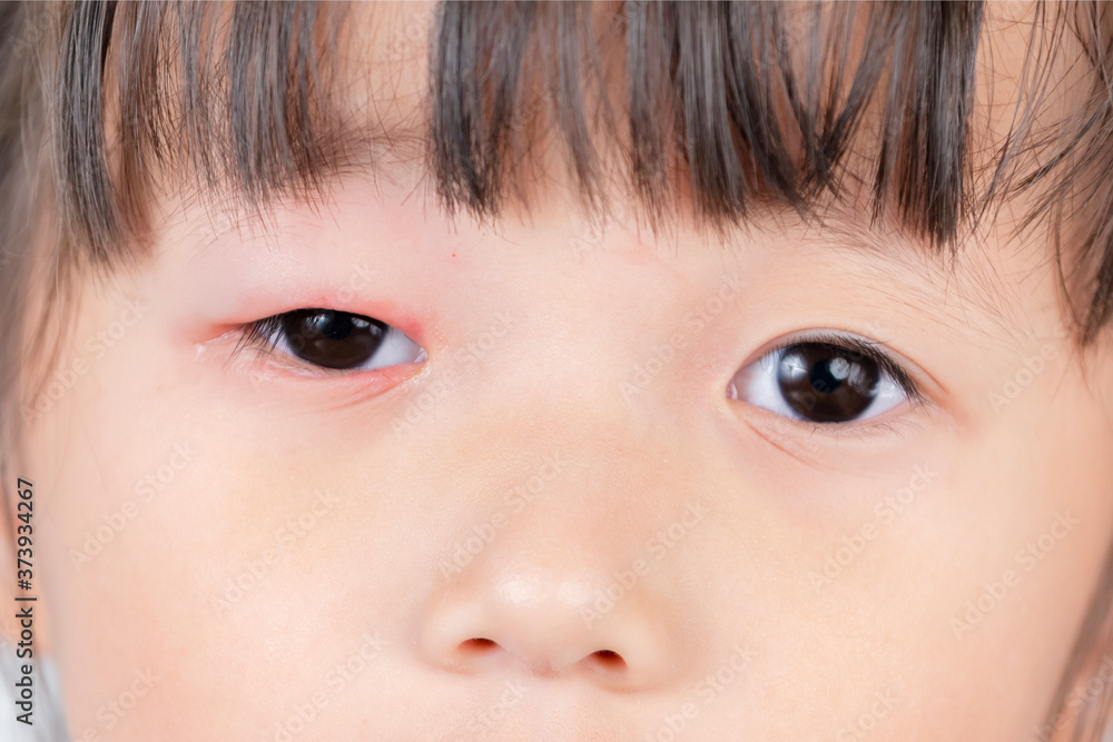 Close up red pink eye inflammation blepharitis from allergy Close up red pink eye inflammation blepharitis from allergy
