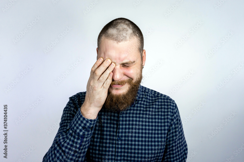 Man with alopecia on head, cry. Spot Baldness, Hair fall problem Man with alopecia on head, cry. Spot Baldness, Hair fall problem
