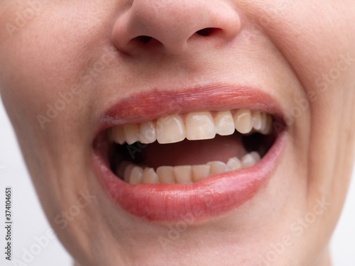 Middle aged woman laughs on white background showing perfect white teeth