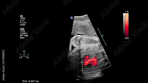 Ultrasound screen with fetal echocardiography.