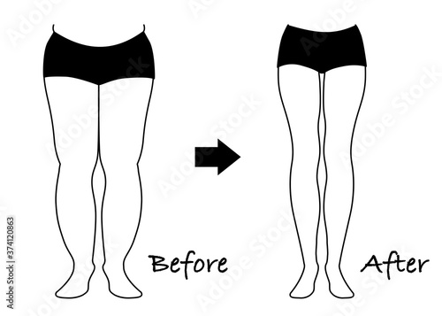 ダイエット　ビフォーアフター（脚やせ）モノクロ
