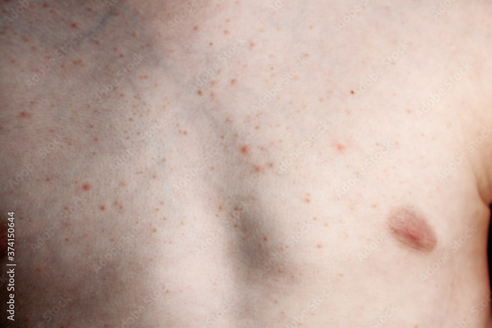 Fototapeta premium Close up image of a little boy's body suffering severe urticaria, nettle rash also called hives
