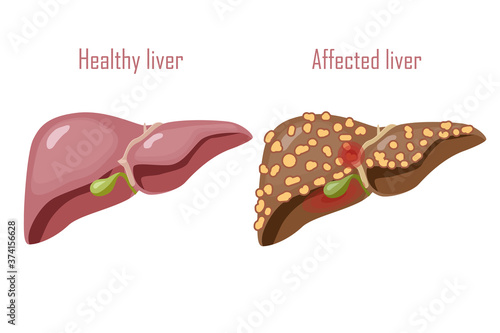 Human liver, digestive system. Healthy and diseased liver, cirrhosis. Vector illustration