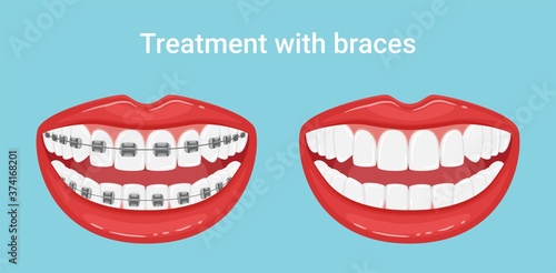 Teeth in the mouth with or without braces. During and after orthodontic treatment. The alignment of the teeth. Healthy lifestyle and dental care. White even teeth in a smile. Isolated flat vector.