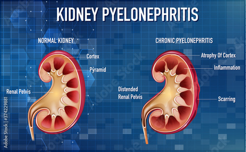 Informative illustration of Pyelonephritis