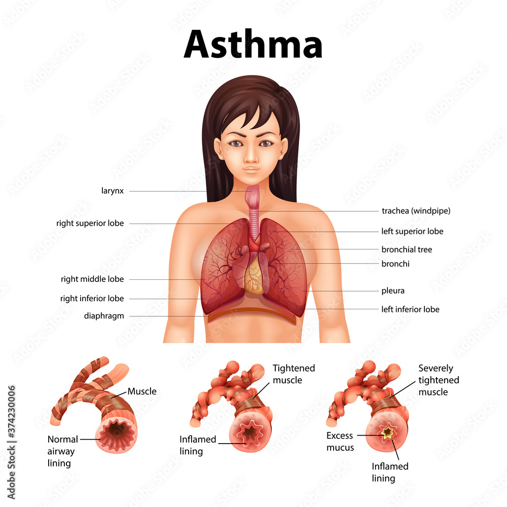 Obraz premium Comparison of healthy lung and Asthmatic lung