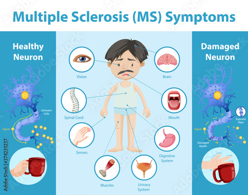 Multiple sclerosis (MS) symptoms information infographic