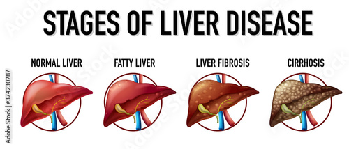 Stages of liver disease