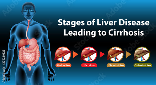 Stages of liver disease leading to Cirrhosis