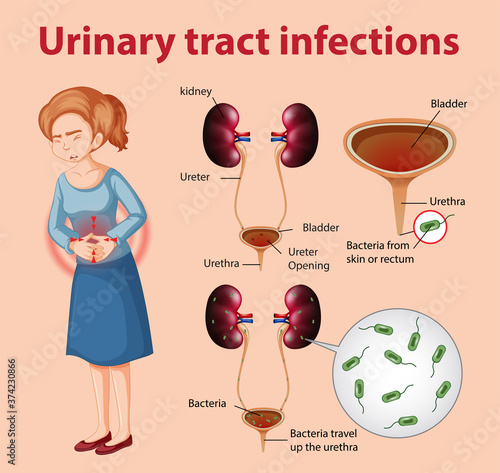 Informative illustration of urinary tract infections
