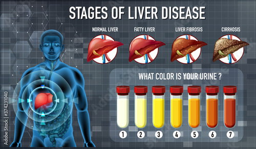 Stages of liver disease