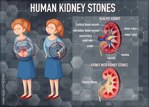Comparison of healthy kidney and kidney with stones
