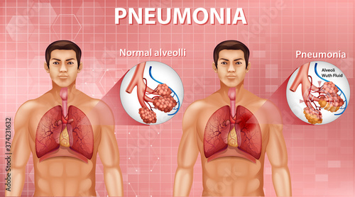 Comparison of healthy alveoli and Pneumonia