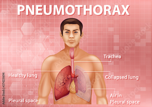 Informative illustration of Pneumothorax