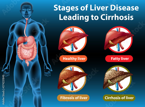 Stages of liver disease leading to Cirrhosis