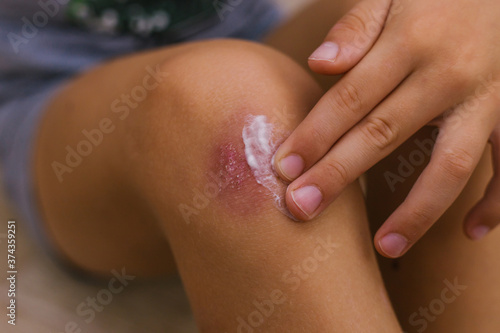 The child smears cream on the damaged skin on the leg. Dry skin and irritation. Allergic reactions.