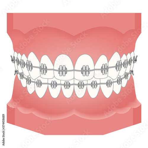 歯列矯正　矯正器具 photo