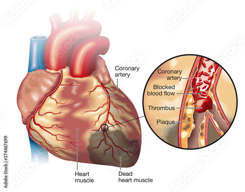 Bild auf Leinwand Cardiac infarction, medically accurate illustration