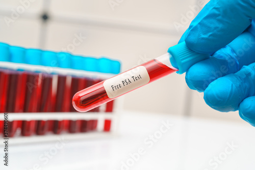 Blood sample   test tube in doctor hand for   H7N9 PSA   diagnosis for prostate cancer   test photo