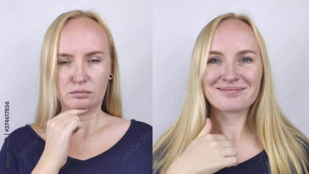 Second chin lift in women. Photos before and after plastic surgery, mentoplasty or facebuilding. Chin fat removal and face contour correction Second chin lift in women. Photos before and after plastic surgery, mentoplasty or facebuilding. Chin fat removal and face contour correction