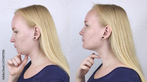 Second chin lift in women. Photos before and after plastic surgery, mentoplasty or facebuilding. Chin fat removal and face contour correction