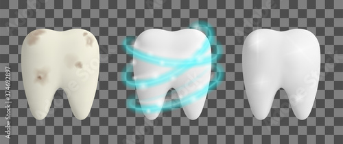 Clean and dirty tooth. Teeth Whitening process. Dental health design concept. Realistic vector illustration.