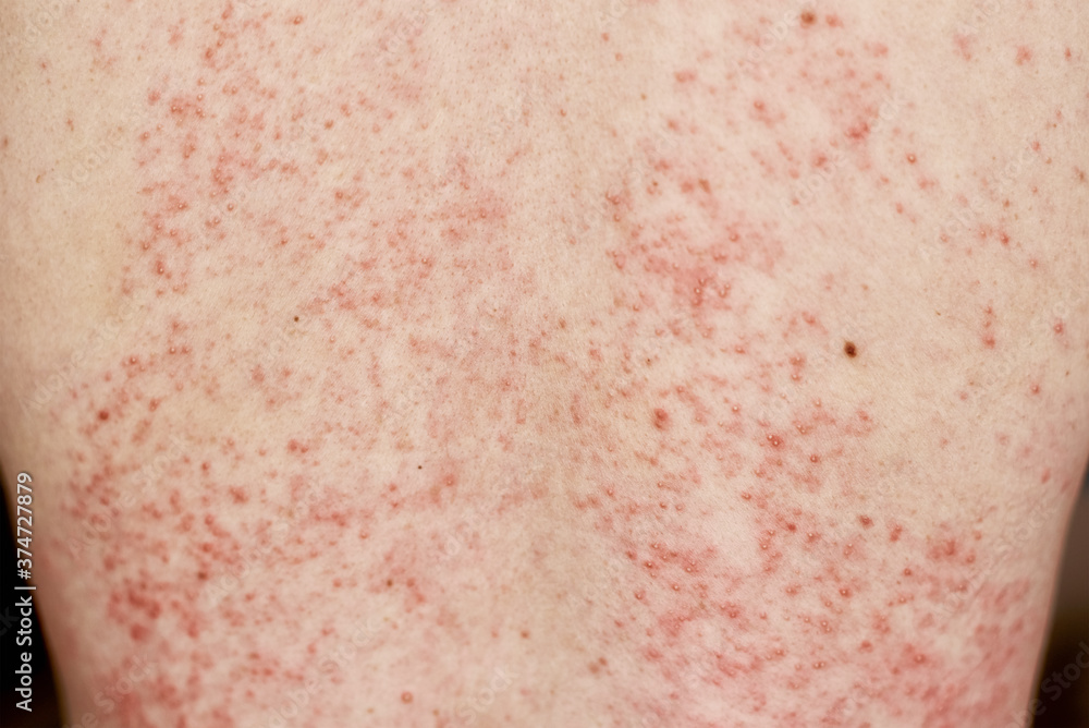 Allergic rash on skin. Woman with dermatology problem on back skin