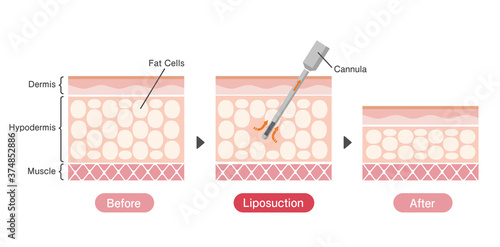 Liposuction process vector illustration / sectional view of skin