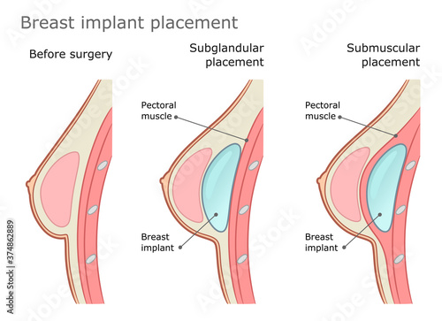 Breast implant placement diagram. Subglandular and submuscular placement types. Plastic surgery of breast implants.  photo