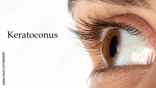 Macro eye photo. Keratoconus - eye disease, thinning of the cornea in the form of a cone. The cornea plastic. Close up, banner. photo