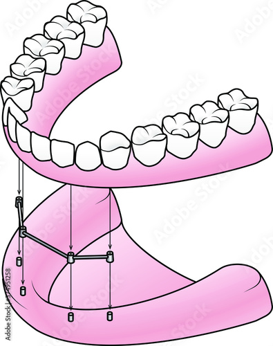 Implant-secured removable denture: A removable full denture attaching to a bar retainer that is in turn attached to four implant posts.