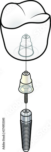 Diagram showing the main parts of an endosteal / endosseous dental implant: crown / prosthesis, abutment and implant post.