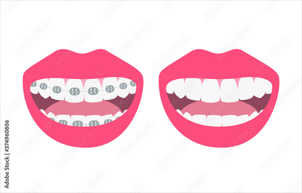 Happy smiles showing before and after alignment and whitening teeth process. Alignment of bite of teeth, dental row with braces, Orthodontic healthcare concept. Vector illustration Happy smiles showing before and after alignment and whitening teeth process. Alignment of bite of teeth, dental row with braces, Orthodontic healthcare concept. Vector illustration