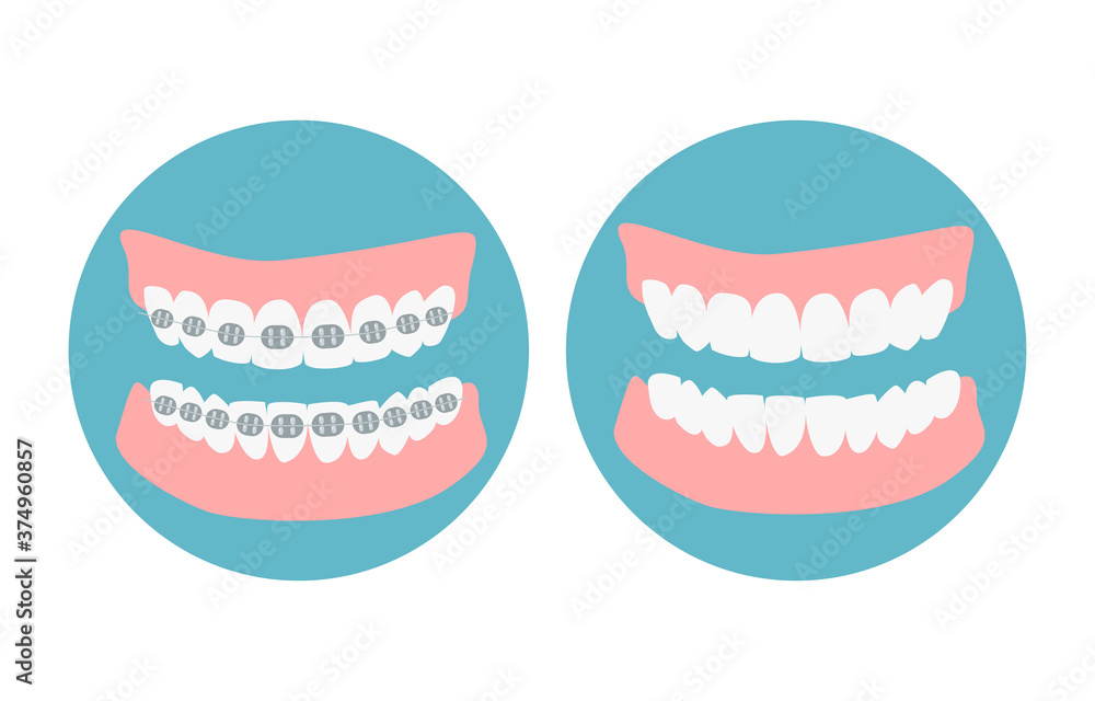 Before and after alignment teeth process. Alignment of bite of teeth, dental row  with braces, Orthodontic healthcare  concept. Vector illustration