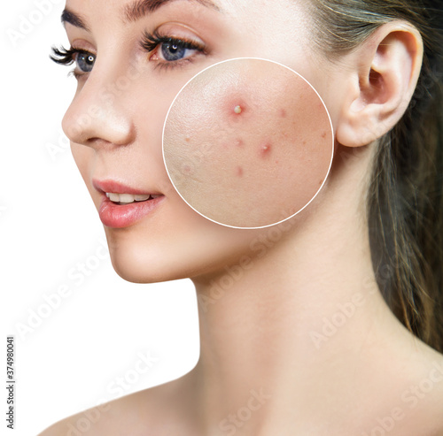 Face of young woman with zoom circle before and after acne treatment. Beautician concept.