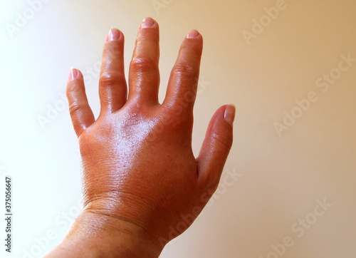 Schilderij op canvas The left arm was severely swollen after a bee sting, which left its sting in the skin with poison