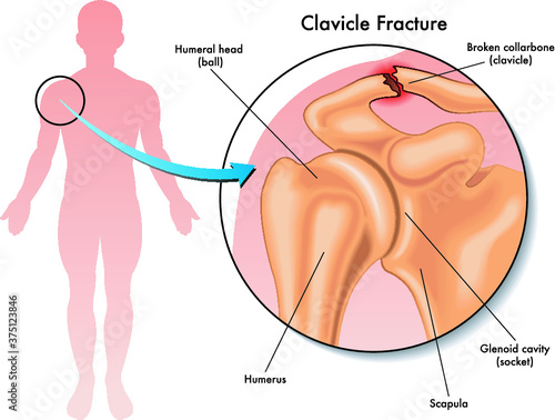 Medical illustration of a clavicle fracture and its location in the human body, with annotations.