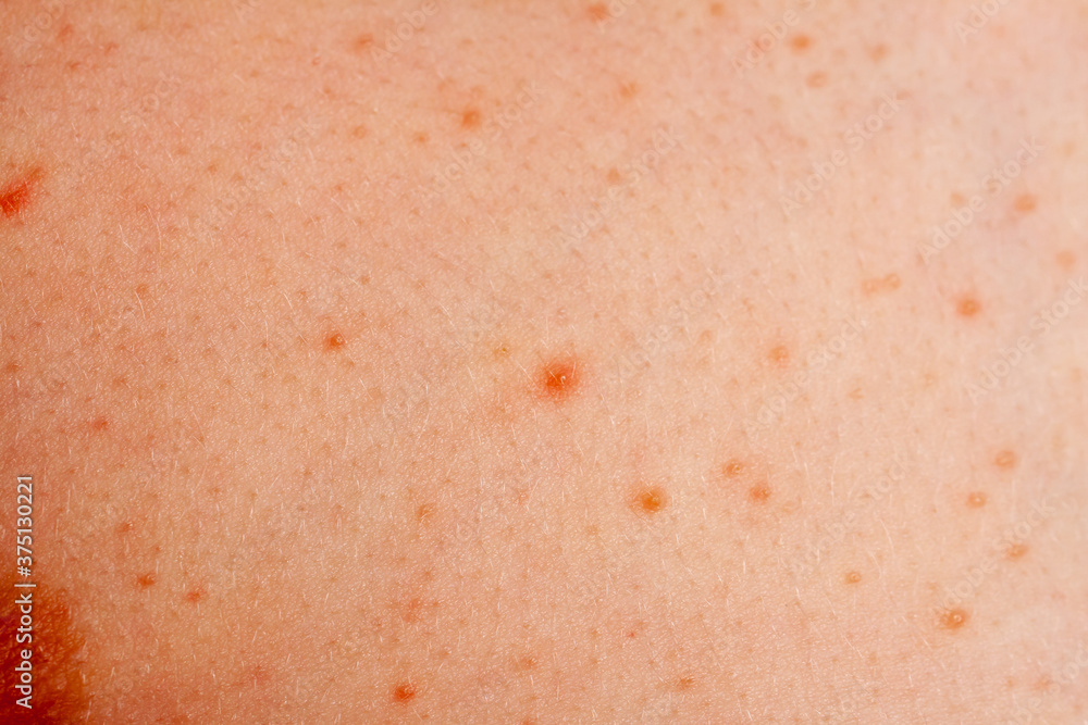 Close up image of a little boy's body suffering severe urticaria, nettle rash also called hives Close up image of a little boy's body suffering severe urticaria, nettle rash also called hives