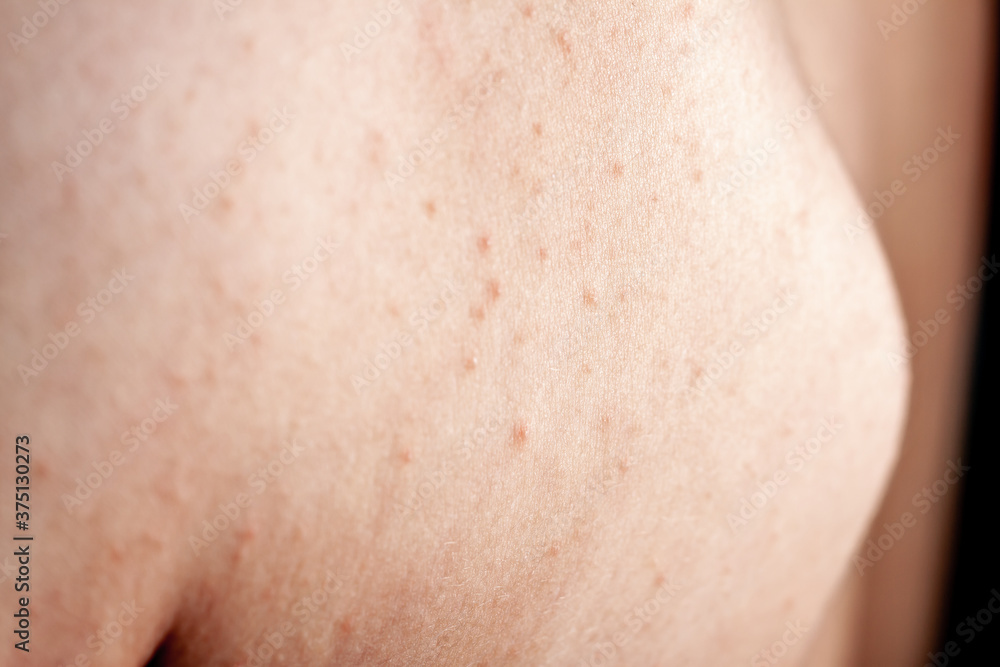 Close up image of a little boy's body suffering severe urticaria, nettle rash also called hives Close up image of a little boy's body suffering severe urticaria, nettle rash also called hives