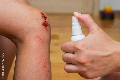 Woman sprays an antiseptic agent on the wound on the child?s knee. Treatment the wound. First Aid