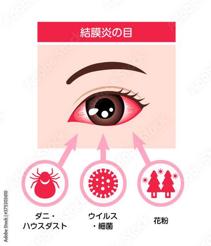 結膜炎の目 イラスト（結膜炎の原因）