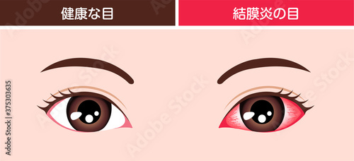 結膜炎と通常の目の比較イラスト
