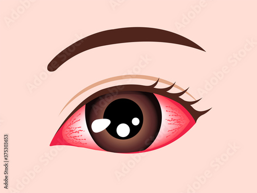 Conjunctivitis (pink eye) vector illustration