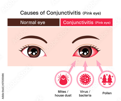 Causes of conjunctivitis (pink eye) vector illustration